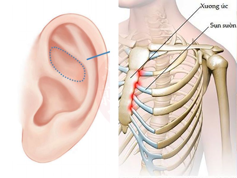 Cả sụn tai và sụn sườn nâng mũi đều là sụn tự thân có độ bền cao an toàn cho sức khỏe