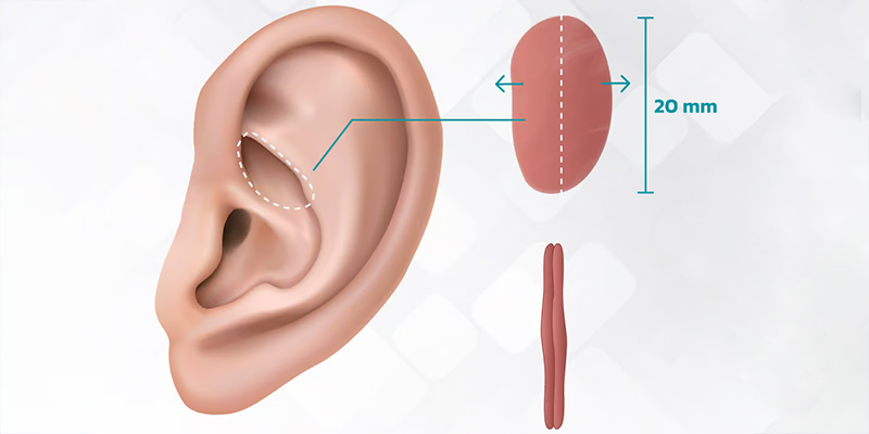 Mô tả vị trí lấy sụn tai, ví trí không lộ sẹo, khó nhìn thấy sẹo nếu không quan sát kỹ và không ảnh hưởng đến cấu trúc, chứng năng vùng tai