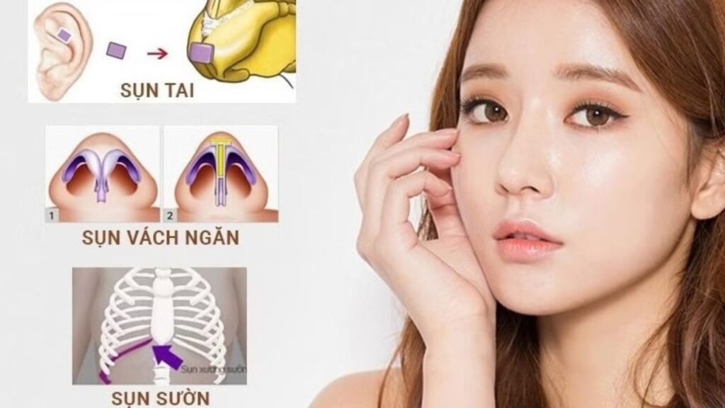 Sụn tự thân nâng mũi là gì? Phân tích ưu nhược điểm các loại sụn và tiêu chuẩn lựa chọn.