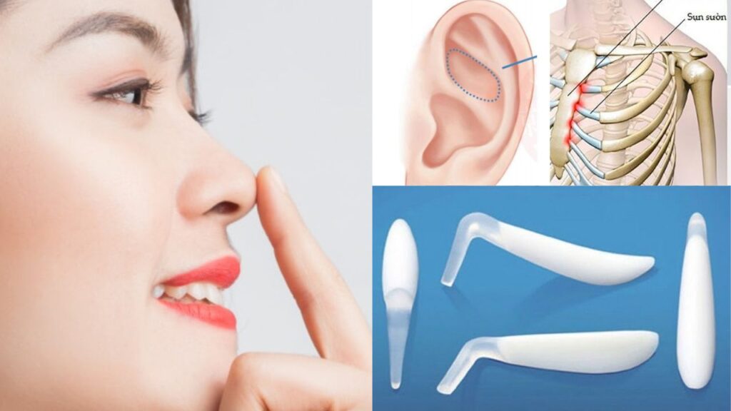 So sánh sụn tự thân và sụn nhân tạo: Lựa chọn nào “đắt giá” cho dáng mũi trọn đời?