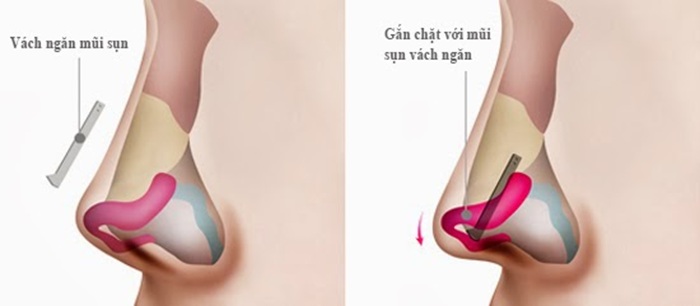 Sụn vách ngăn không ảnh hưởng tới đường thở mà vẫn tạo dáng mũi chuẩn, đúng form