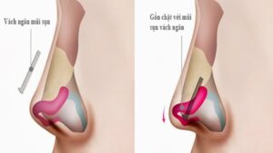 Sụn vách ngăn nâng mũi là gì? Giải pháp dựng trụ mũi vững chãi và 3 sự thật về hô hấp