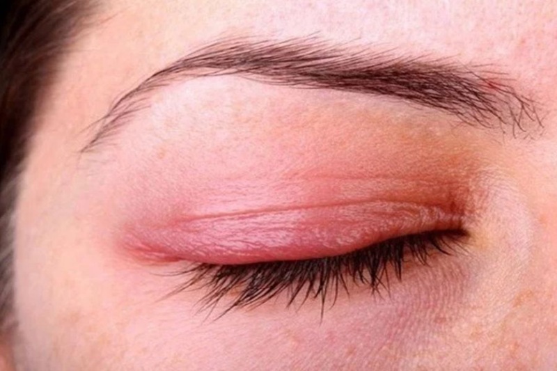 Mí mắt sưng đau có hiện tượng chảy mủ là dấu hiệu nhiễm trùng sau khi cắt mí cần đi thăm khám ngay