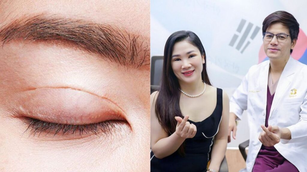 Lịch tái khám sau cắt mí chuẩn Y khoa: Vì sao không được bỏ lỡ mốc 7 ngày?