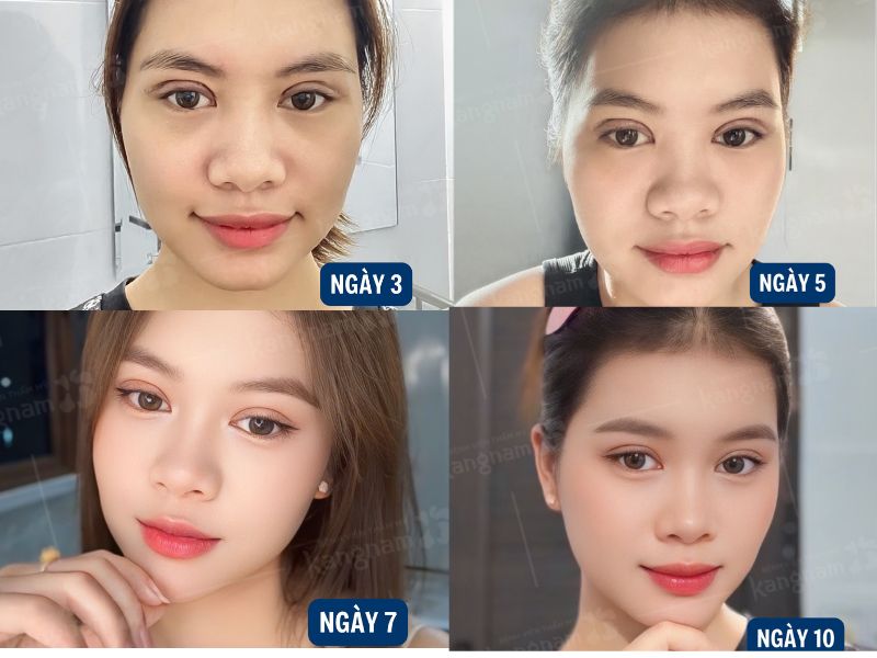 Các mốc thời gian hồi phục sau khi cắt mí mắt từ sưng đau đến hồi phục hoàn toàn nếp mí rõ ràng, không sẹo, sắc nét và hài hòa với khuôn mặt