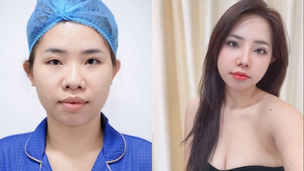 Tái cấu trúc mũi toàn diện cho cô nàng Thanh Hằng tại Kangnam Sài Gòn