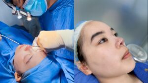 Chỉ 45 phút nâng mũi du học sinh Thanh Thảo lột xác dáng mũi tại Kangnam Hà Nội