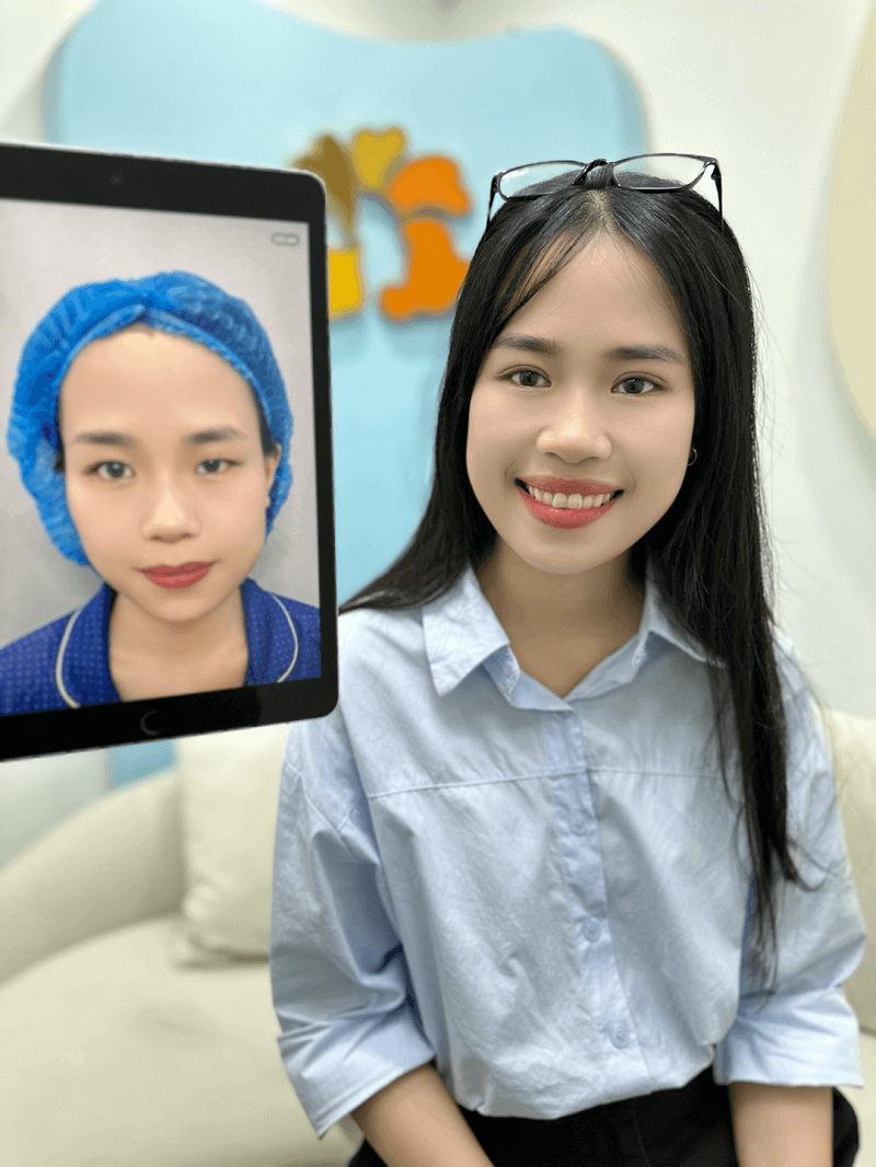 Sau cắt mí nếp mí to tròn, cân đối