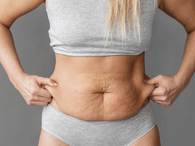 Sự thiếu hụt collagen và Elastin khiến vùng hút mỡ lồi lõm