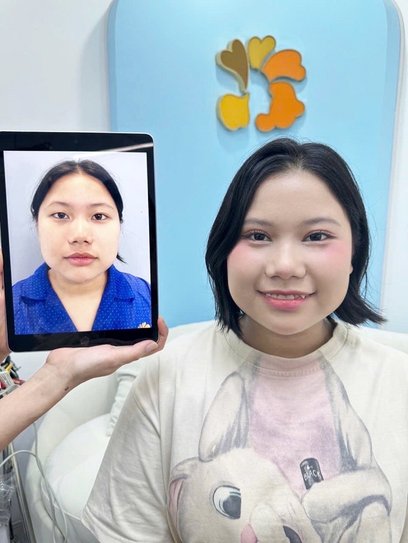 Hình ảnh trước và sau khi cắt mí của Thúy Hằng