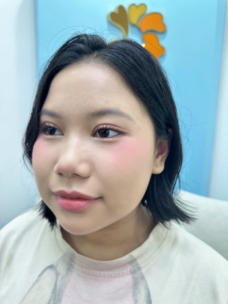 Hằng sở hữu nếp mí tự nhiên, cân đối chỉ sau 7 ngày