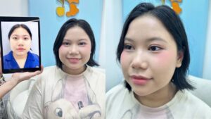 Tạm biệt mí lót, mí lệch: Thúy Hằng tự tin hơn sau cắt mí tại Kangnam Hà Nội