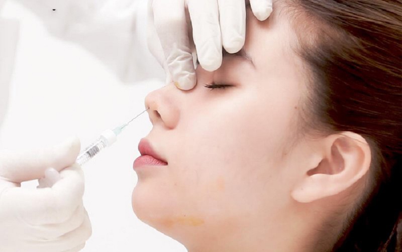 Quy trình nâng mũi bằng Filler và chỉ sinh học ít xâm lấn không gây đau đớn cho người sợ dao kéo.