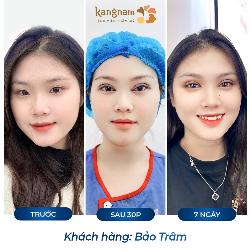 Quá trình phục hồi của khách hàng sau cắt mí