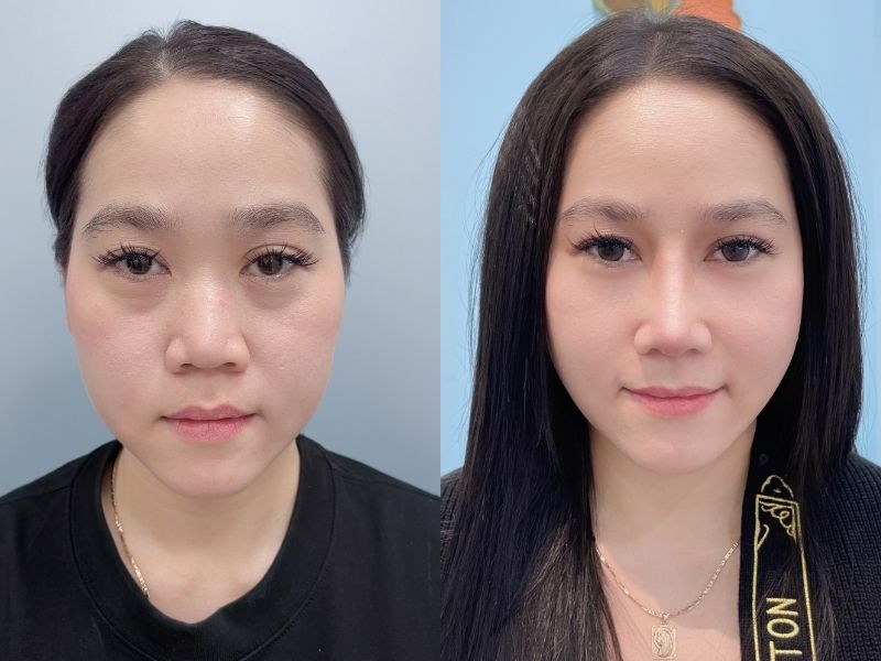 Tina sở hữu dáng mũi cao, thon gọn tự nhiên chỉ sau 7 ngày