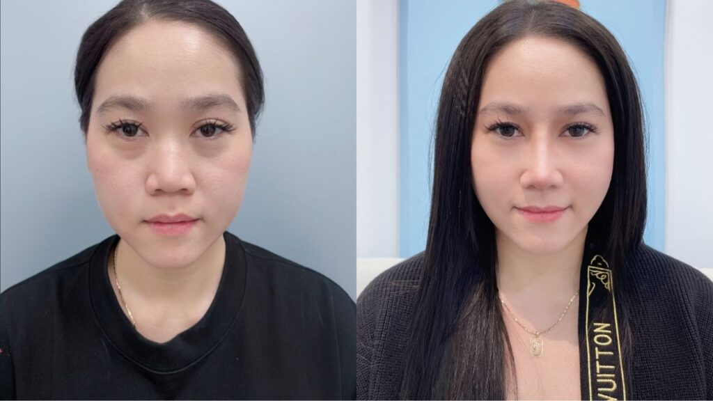 Hành trình “lột xác” dáng mũi cho khách hàng Việt kiều tại Bệnh viện Thẩm mỹ Kangnam Sài Gòn