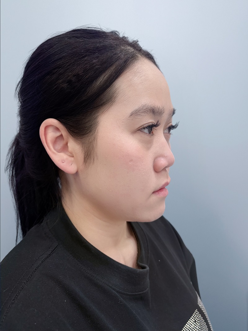 Tina gặp tình trạng sống mũi thấp tẹt, cánh mũi to bè