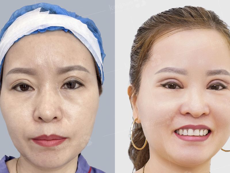 Tái sửa mí lệch, thiếu cân đối