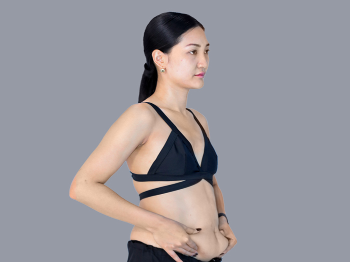 khách hàng gặp tình trạng mỡ bụng dưới lâu năm có thể cân nhắc hút mỡ