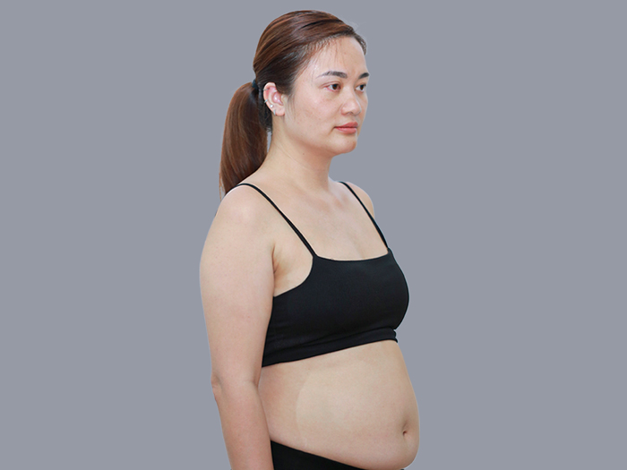 Tình trạng cơ bụng sau sinh và chỉ định hút mỡ, tạo hình thành bụng