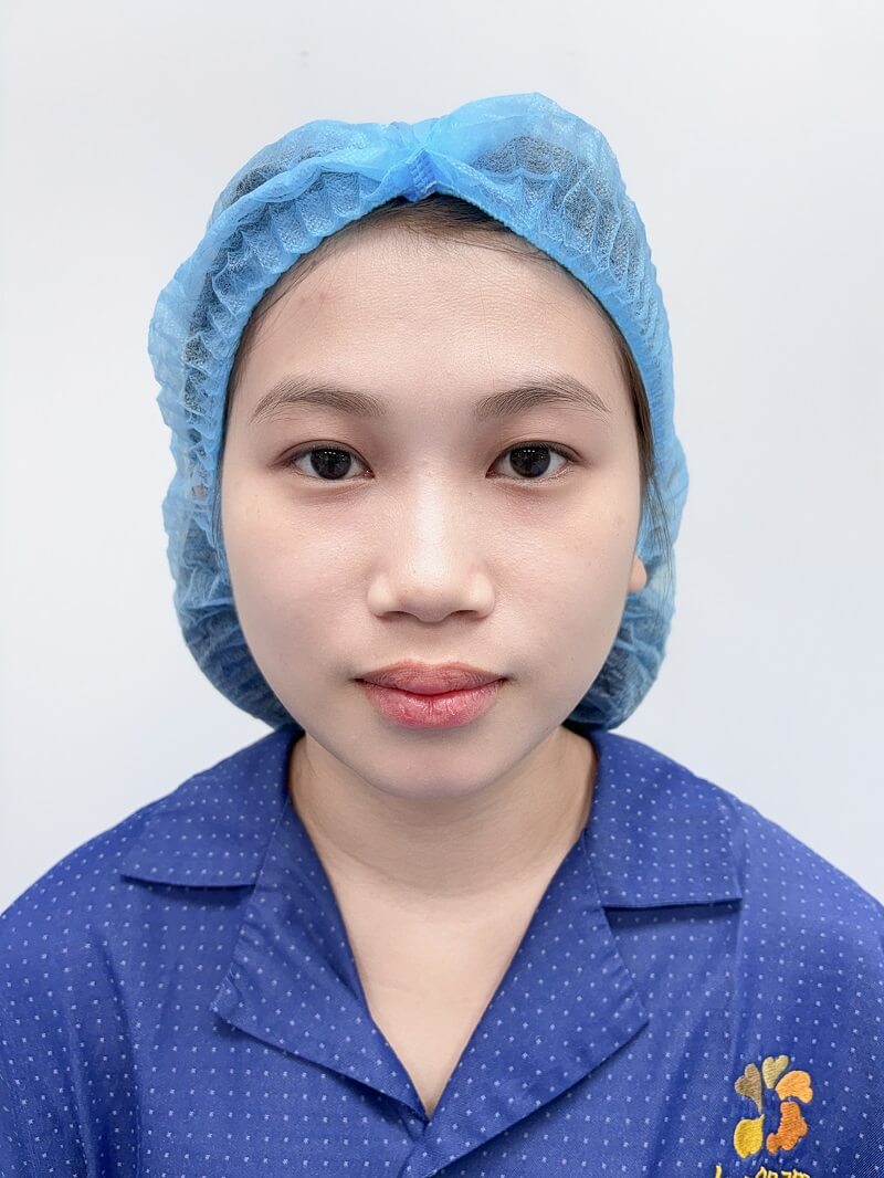 Tình trạng mũi thấp, sống mũi không rõ