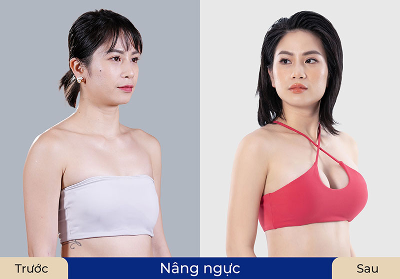 khách hàng nâng ngực tại Kangnam, khách thường xuyên vận động thể thao