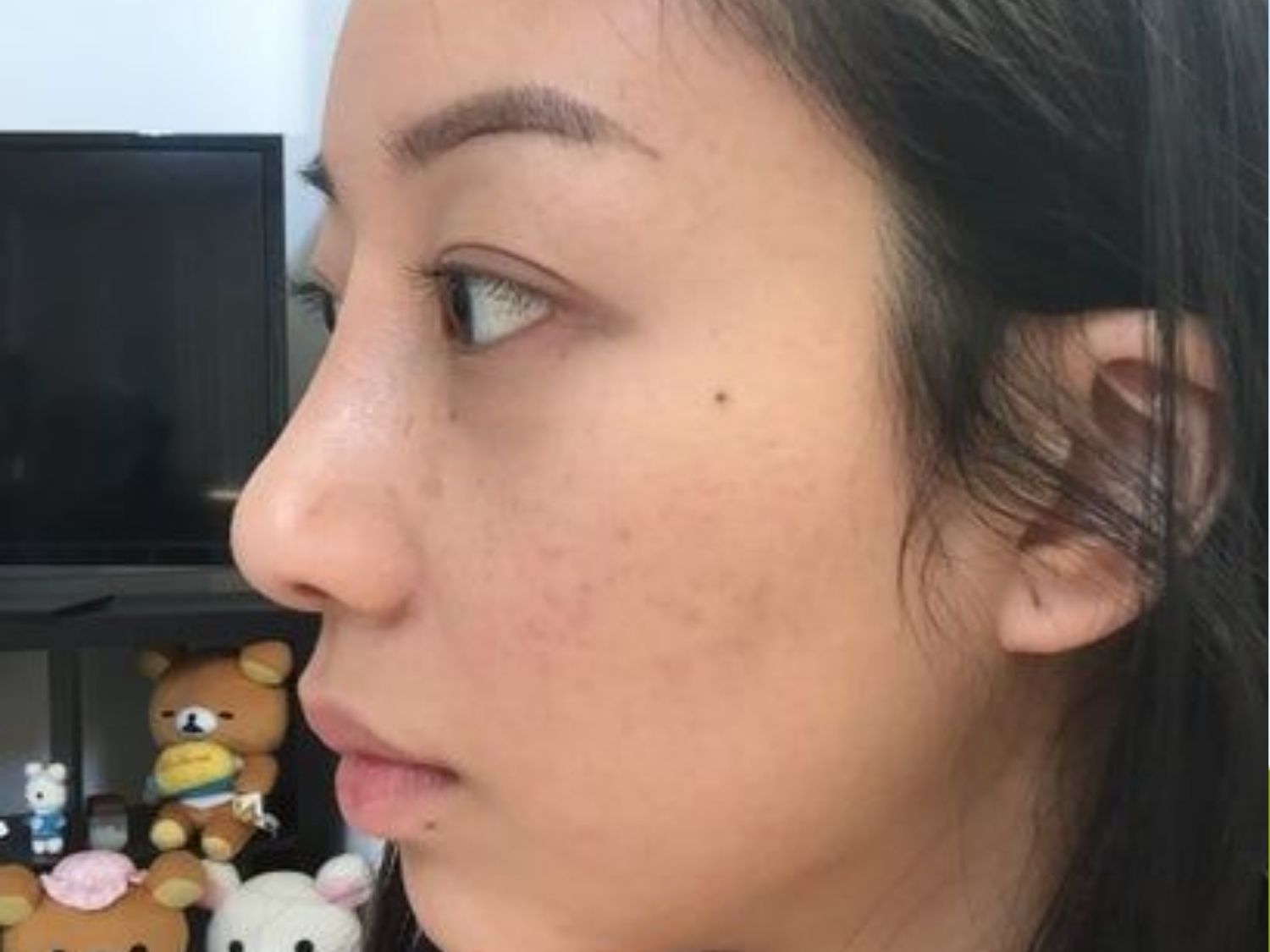 Dáng mũi quá cao, gốc mũi cao không hài hòa với gương mặt