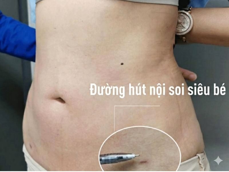 Đường rạch siêu nhỏ sau khi hút mỡ