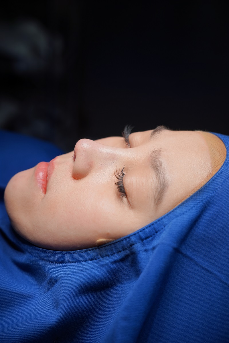 Dáng mũi vừa nâng sau 30 phút