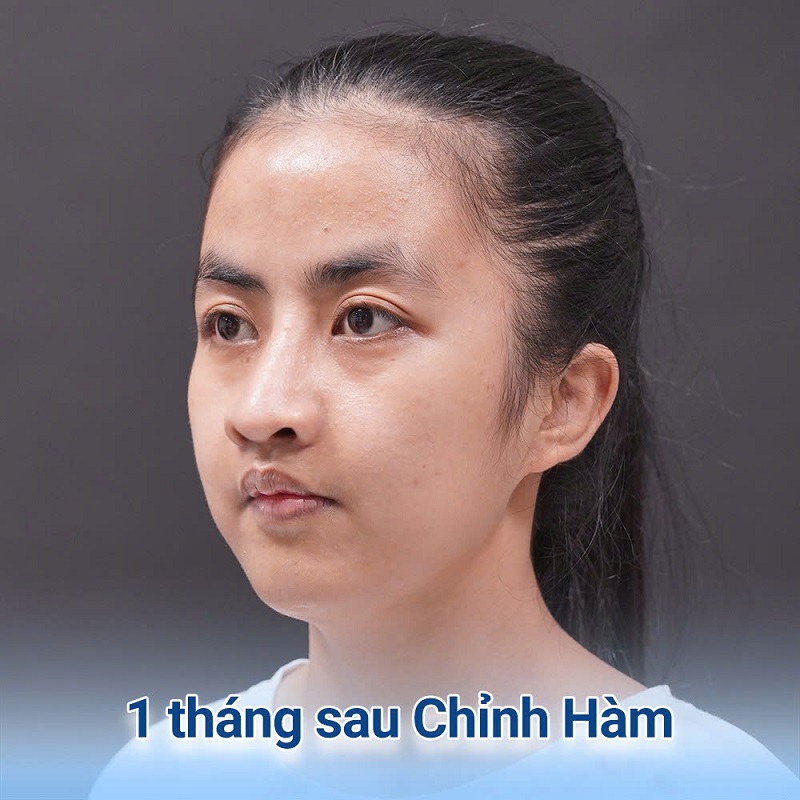 1 tháng sau chỉnh hàm Trà My đã có nét ổn định hơn