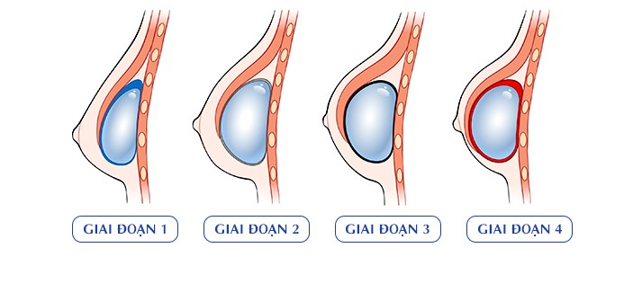 4 cấp độ bao xơ co thắt túi ngực