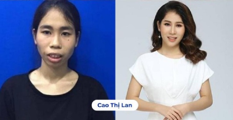 Lớn lên trong hoàn cảnh khó khăn, Lan đã có màn “lột xác” ngoạn mục sau hơn 100 ngày phẫu thuật