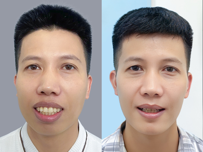 ảnh khách hàng trước và sau khi chỉnh hàm hô tại kangnam, khuôn hàm sau phẫu thuật cân đối, tự nhiên và gương mặt hài hòa