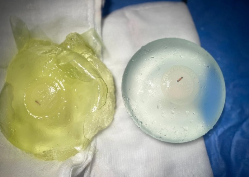 Nguy cơ biến chứng bao xơ khi thực hiện nâng ngực giá rẻ tại các cơ sở thiếu uy tín]