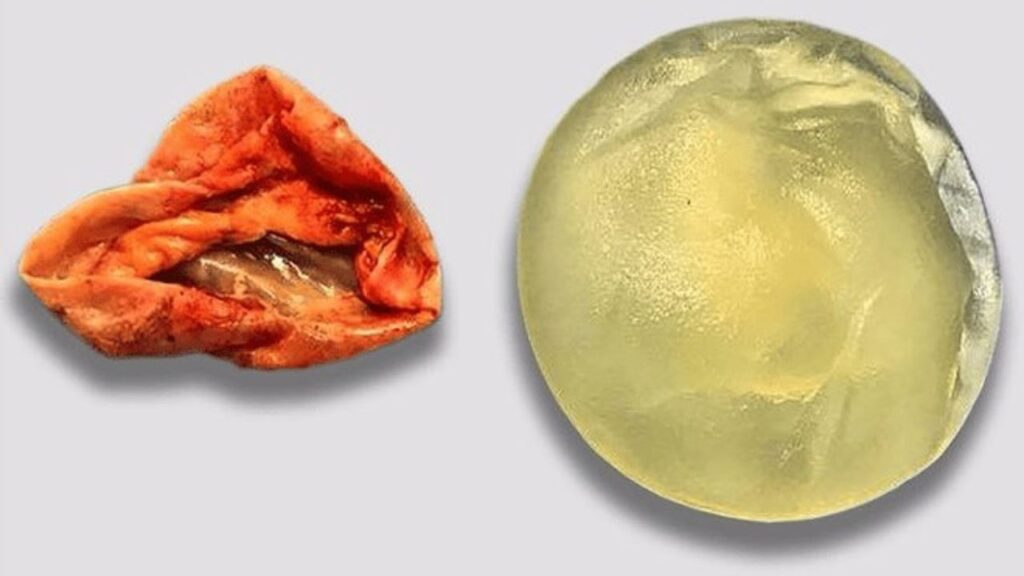 Bao xơ túi ngực là gì? Nhận diện 4 cấp độ Baker và giải pháp khắc phục ngực cứng, biến dạng