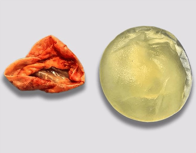 Trường hợp ngực bị co thắt bao xơ túi độn