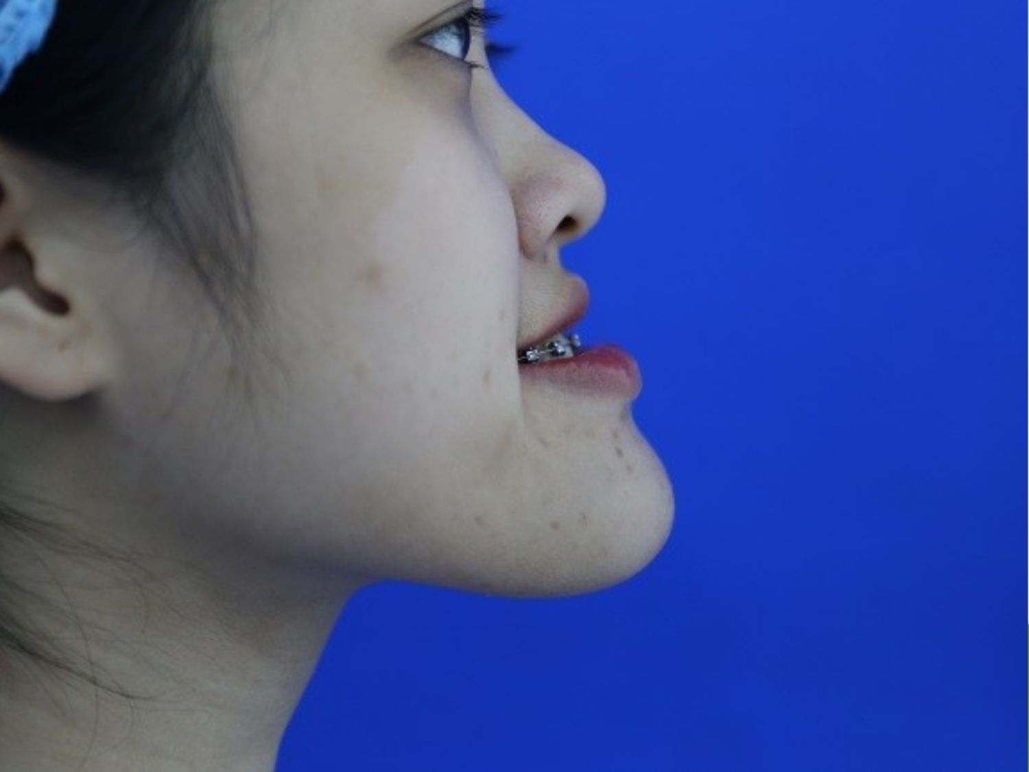 cằm dài do xương hàm quá phát