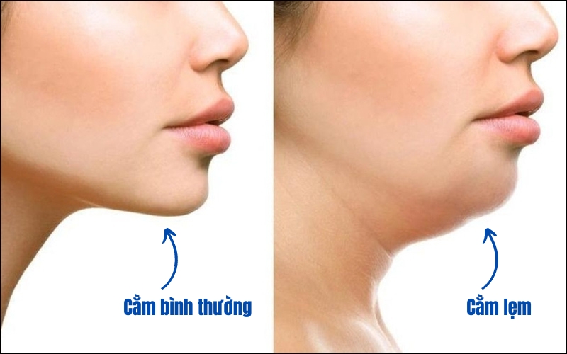 Cằm lẹm, ngắn hơn so với tổng thể gương mặt