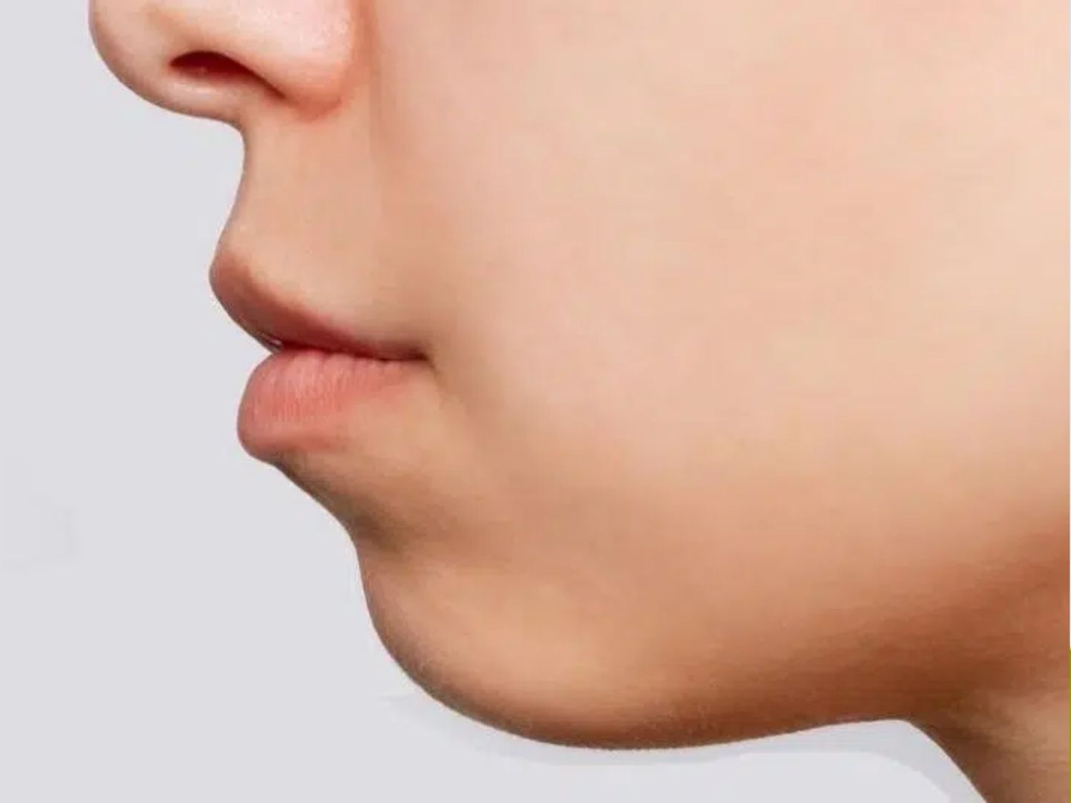 tình trạng cằm lẹm do di truyền