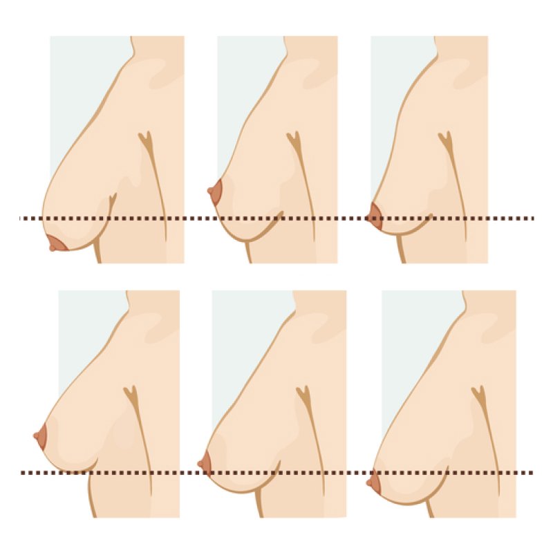 Sơ đồ giải phẫu mô tuyến vú bị teo nhỏ và dây chằng Cooper bị giãn sau khi cai sữa gây sa trễ]