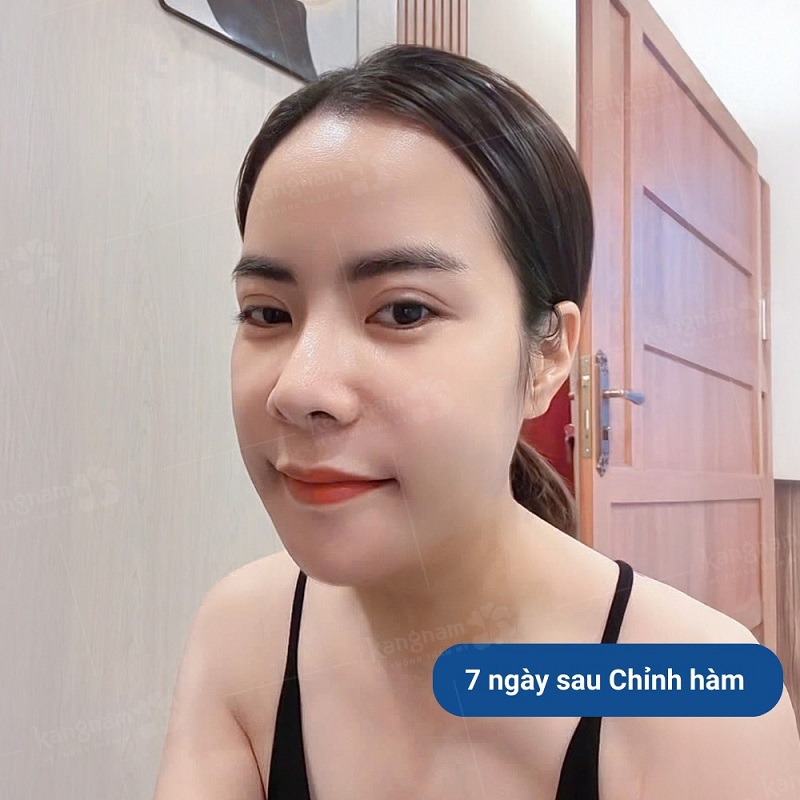 Sau 7 ngày chỉnh hàm gương mặt đã bớt sưng nề