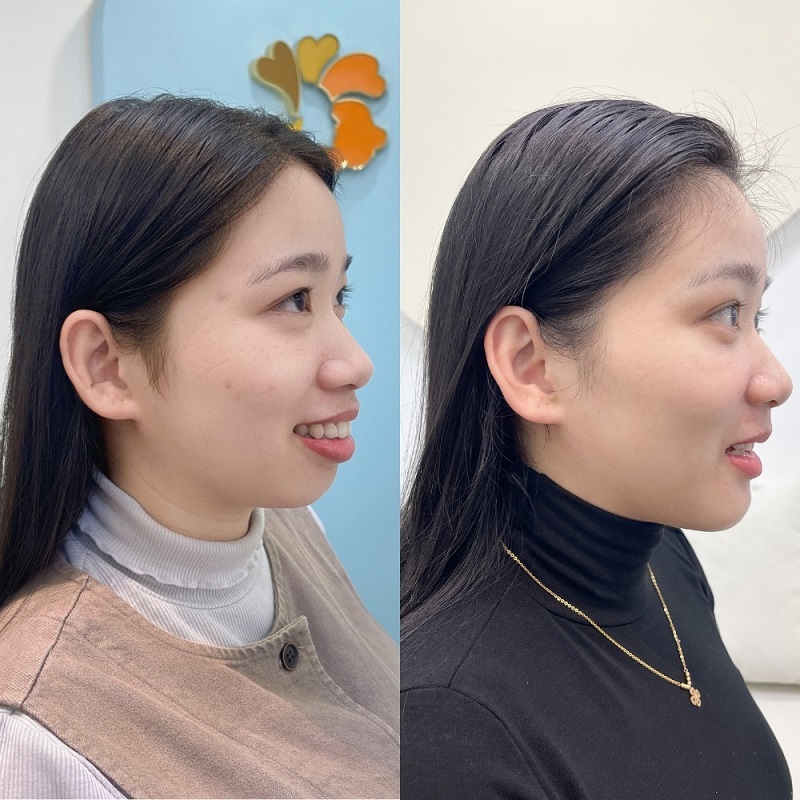 Chỉnh hàm hô do xương cần phẫu thuật để đạt hiệu quả tốt nhất