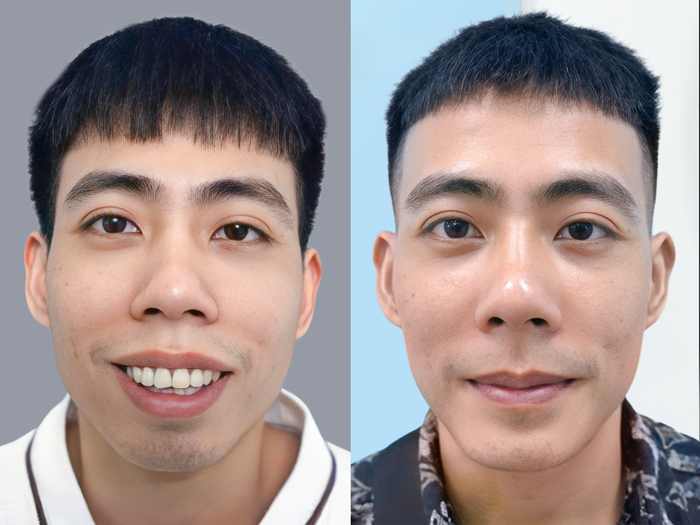 Chỉnh hàm giúp khắc phục tình trạng sai lệch khớp cắn