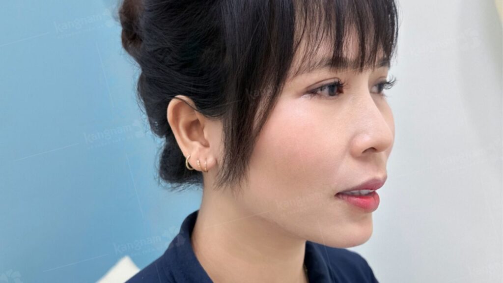 Chỉnh hàm hô bao lâu hồi phục? Thời gian đi làm, ăn uống và sinh hoạt bình thường