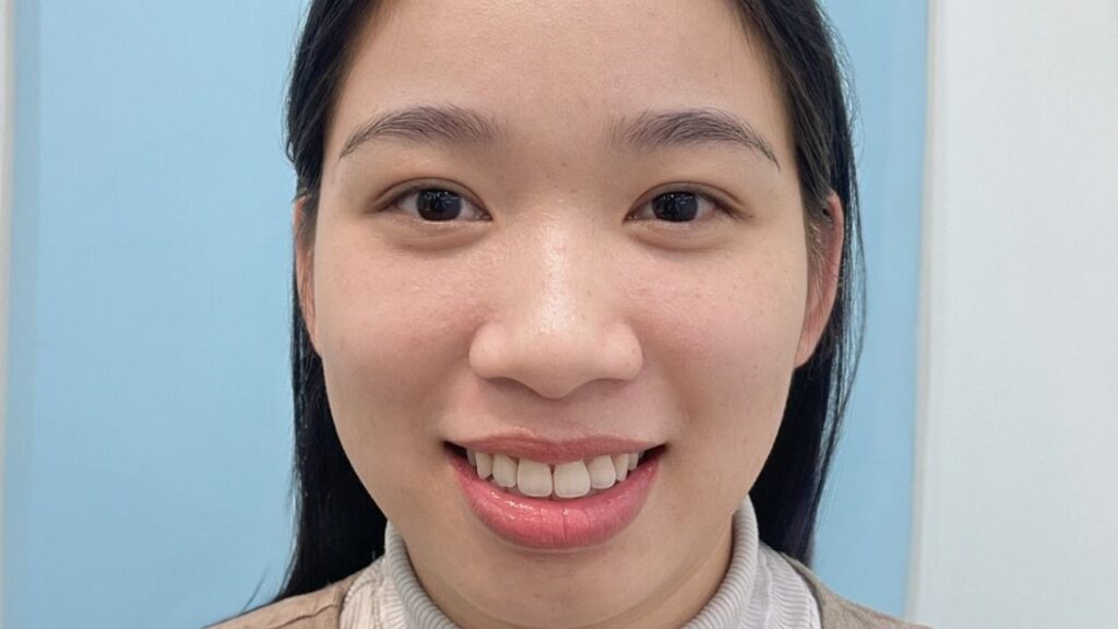 Chỉnh hàm hô có phải mổ xương không? Khi nào cần phẫu thuật