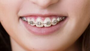 Chỉnh hàm hô khác gì niềng răng? 5 khác biệt cốt lõi và cách chọn đúng phương pháp