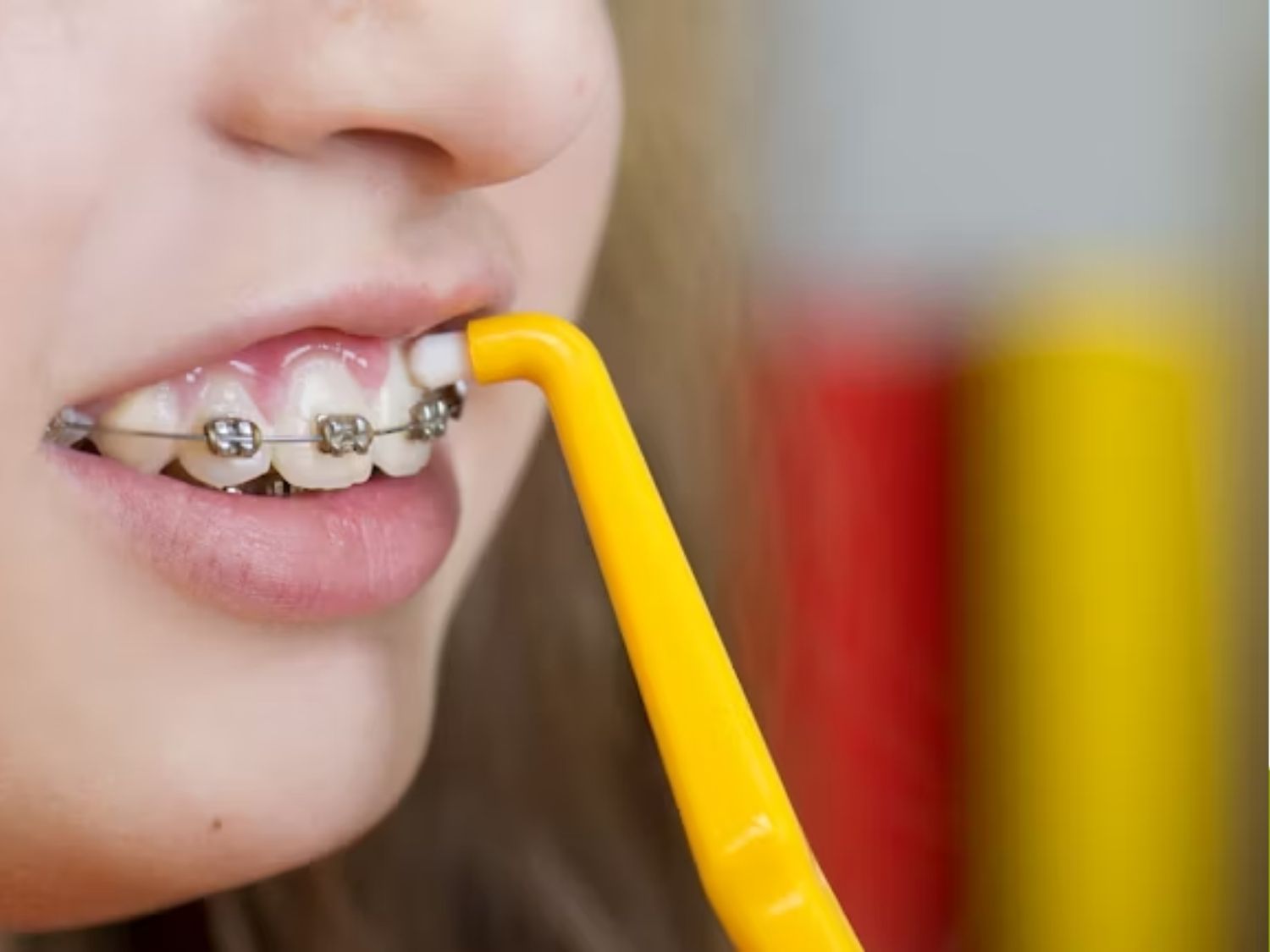 niềng răng cải thiện khớp cắn và giúp răng đều đẹp