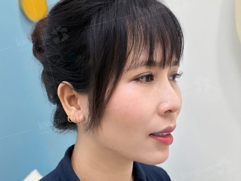 Môi và khớp cắn của khách hàng ổn định sau chỉnh hàm hô