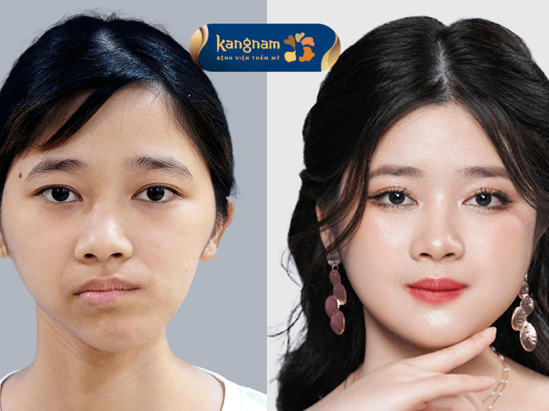 Trường hợp lệch hàm nặng cần phải phẫu thuật sẽ mang lại kết quả tốt và an toàn