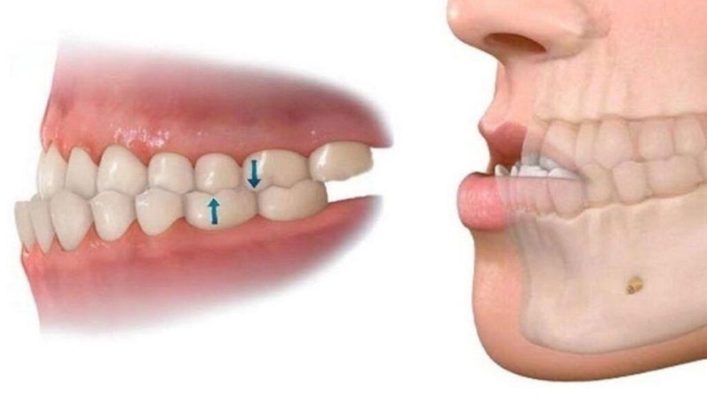 Chỉnh lệch hàm nên niềng răng hay phẫu thuật? 3 tiêu chí chọn đúng phương pháp